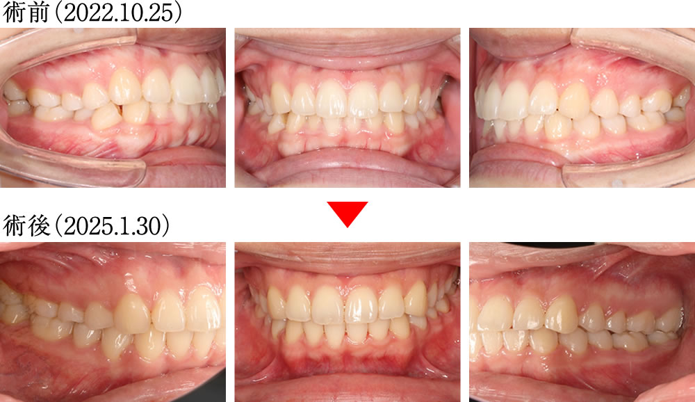 正中のズレ・咬合不良を矯正治療で改善した症例