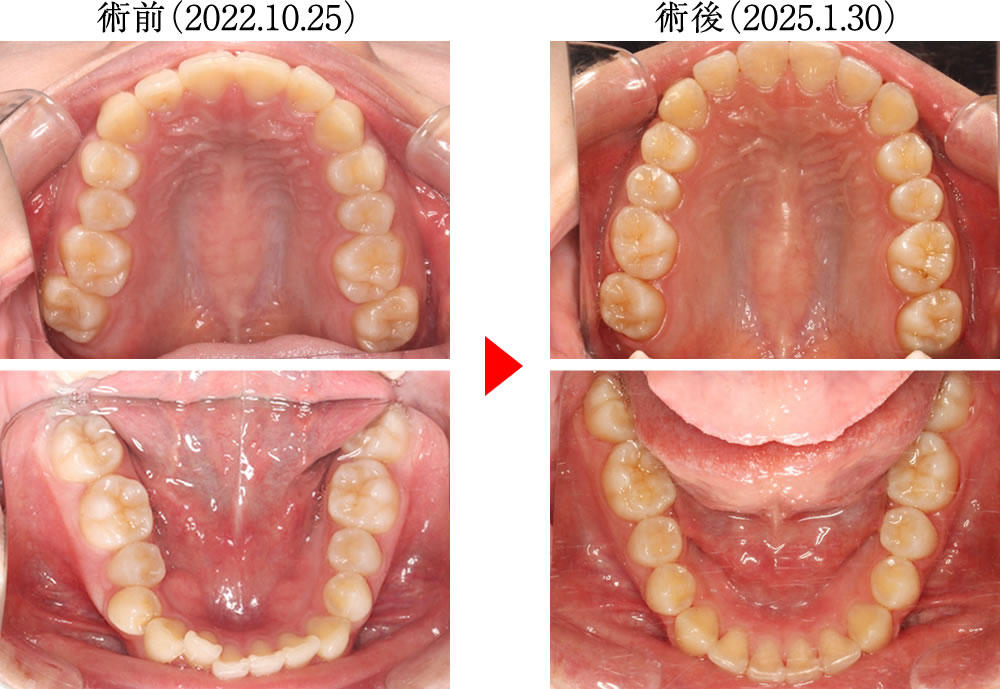 正中のズレ・咬合不良を矯正治療で改善した症例