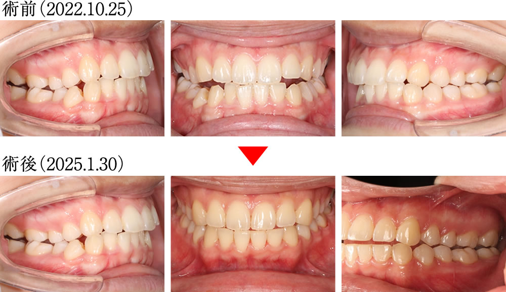 正中のズレ・咬合不良を矯正治療で改善した症例