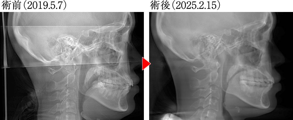 正中のズレ・咬合不良を矯正治療で改善した症例