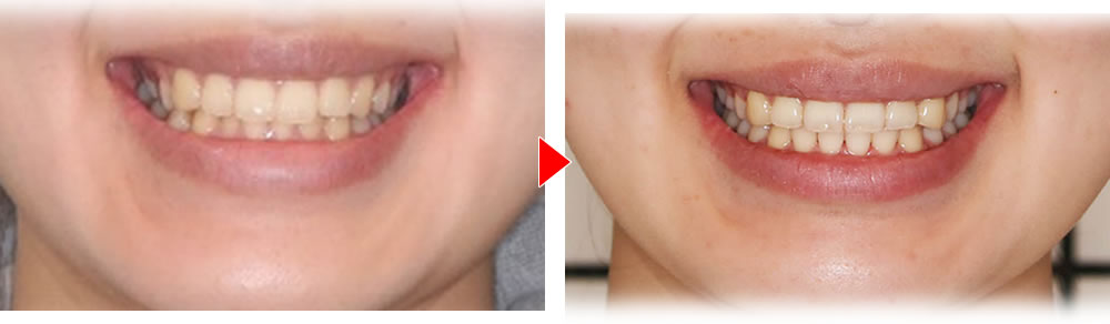 正中のズレ・咬合不良を矯正治療で改善した症例