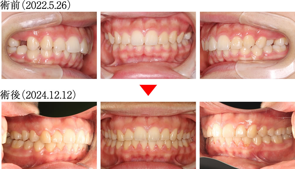 噛み合わせと身体のバランスを矯正治療で改善した症例