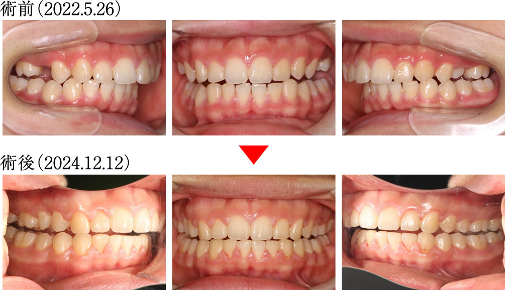 噛み合わせと身体のバランスを矯正治療で改善した症例