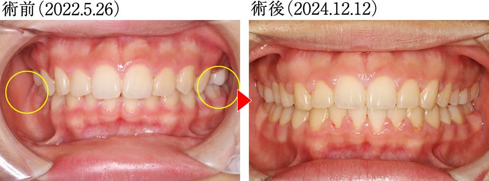 噛み合わせと身体のバランスを矯正治療で改善した症例