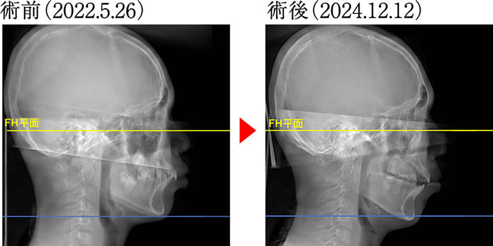噛み合わせと身体のバランスを矯正治療で改善した症例