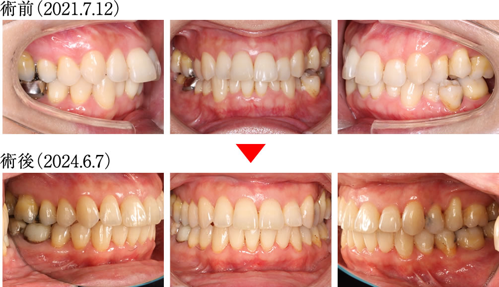歯ぎしり・食いしばりによる様々な不調を矯正治療で改善した症例