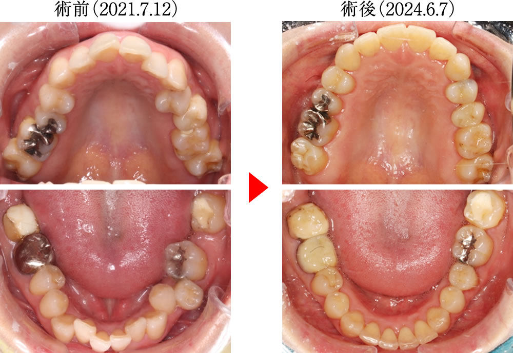 歯ぎしり・食いしばりによる様々な不調を矯正治療で改善した症例