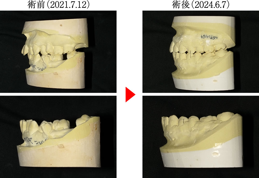 歯ぎしり・食いしばりによる様々な不調を矯正治療で改善した症例