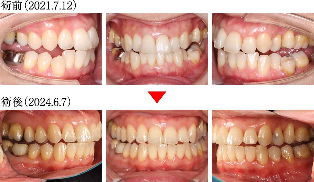 歯ぎしり・食いしばりによる様々な不調を矯正治療で改善した症例