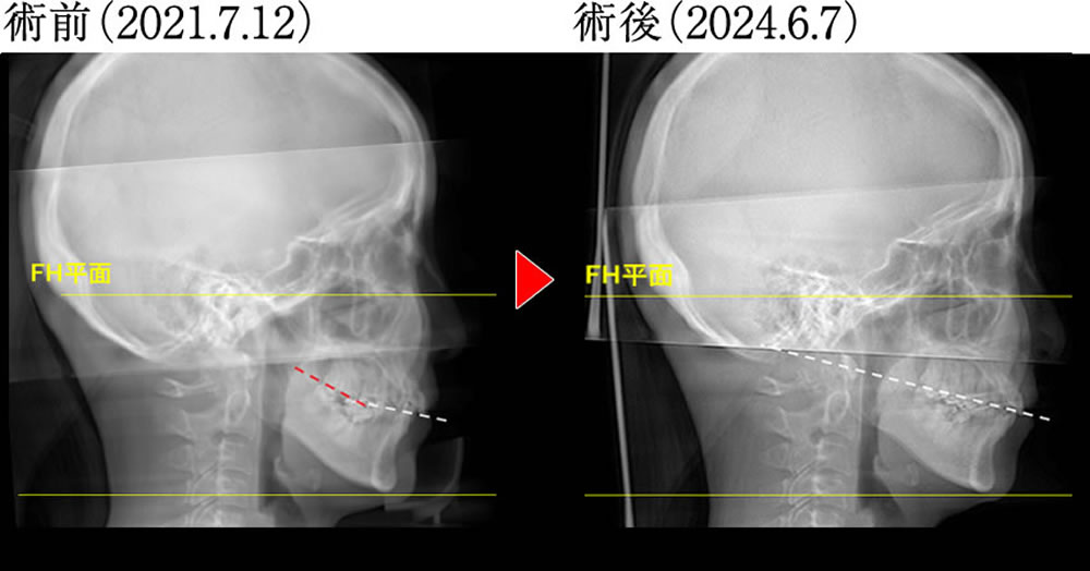 歯ぎしり・食いしばりによる様々な不調を矯正治療で改善した症例