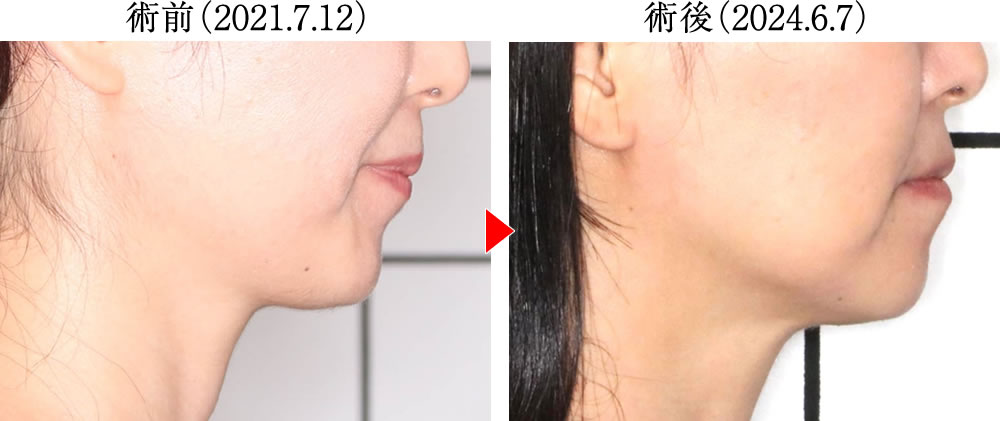 歯ぎしり・食いしばりによる様々な不調を矯正治療で改善した症例