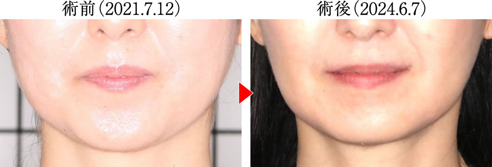 歯ぎしり・食いしばりによる様々な不調を矯正治療で改善した症例
