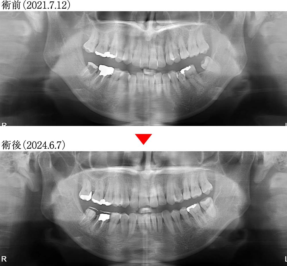 歯ぎしり・食いしばりによる様々な不調を矯正治療で改善した症例