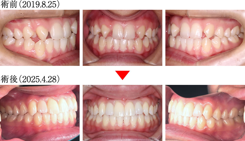 インプラントとマウスピース矯正よって咬み合わせを改善した症例