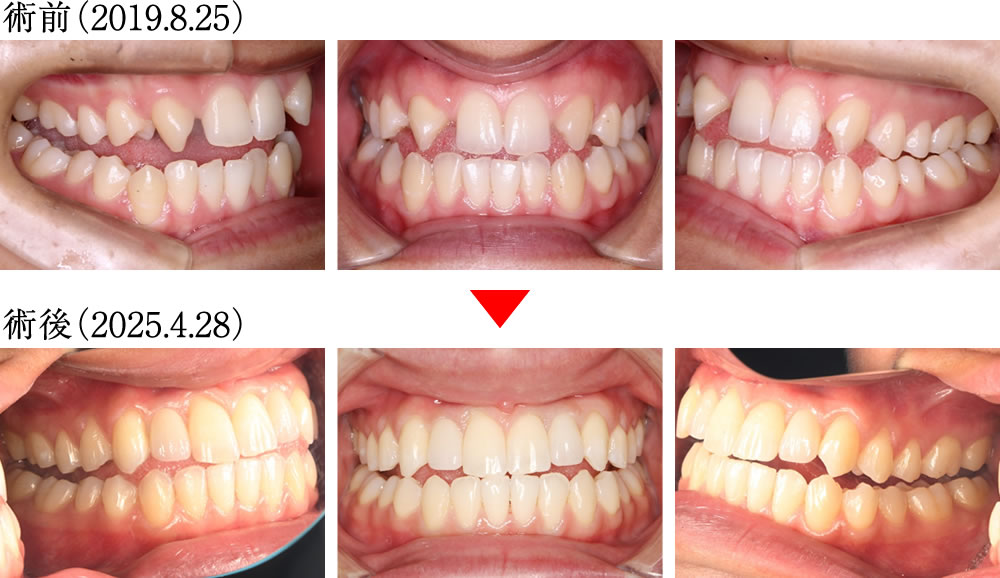 偏心運動の変化
