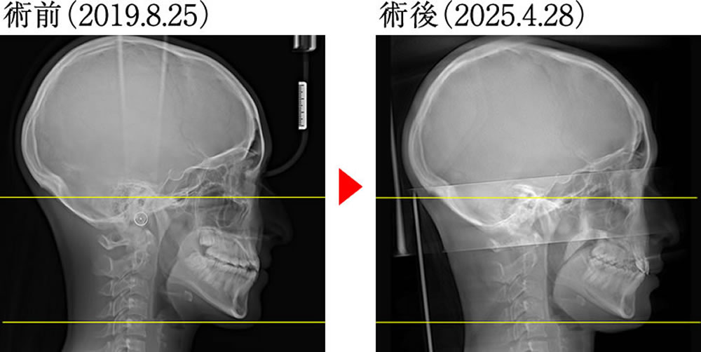 術前術後の骨格の変化