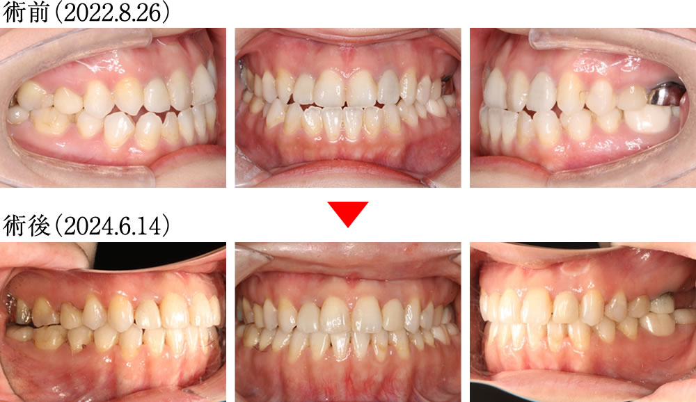インプラントとマウスピース矯正よって咬み合わせを改善した症例