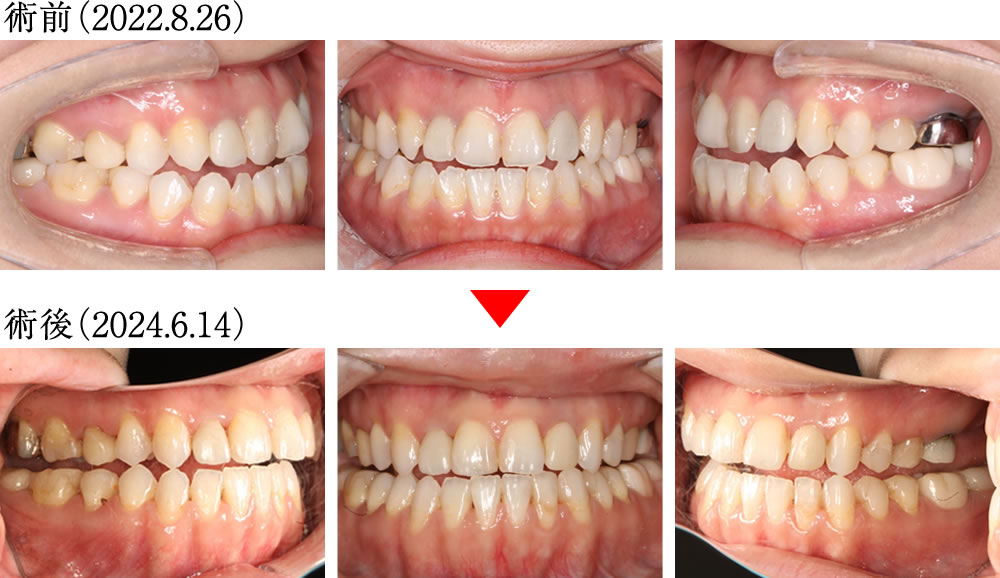 バッカルコリドーの変化