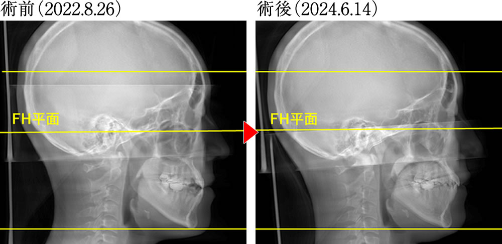 偏心運動の変化