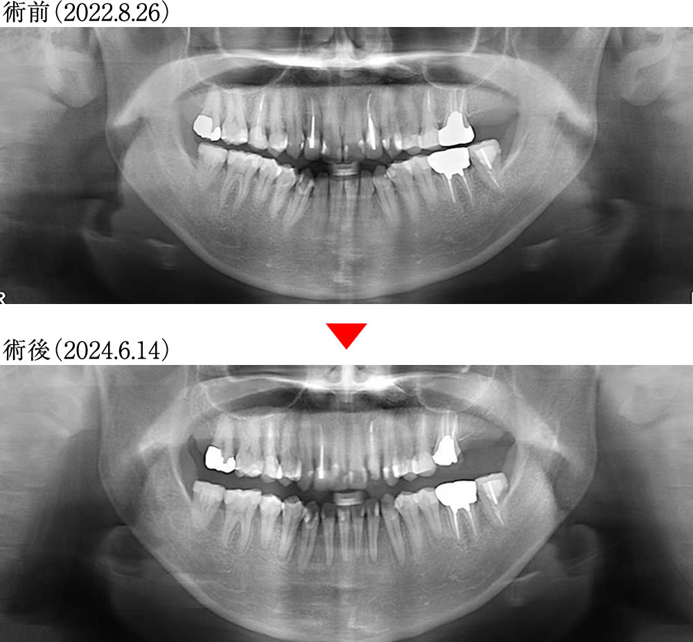術前術後の骨格の変化