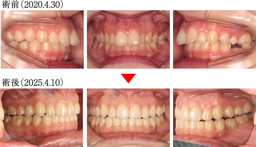 インプラントとマウスピース矯正よって咬み合わせを改善した症例
