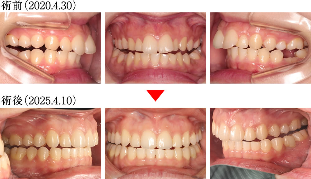 偏心運動の変化