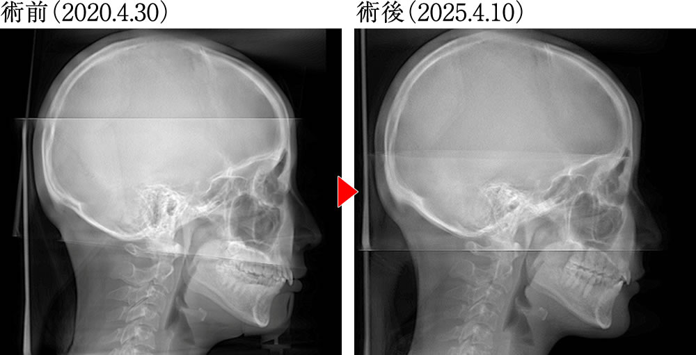 術前術後の骨格の変化