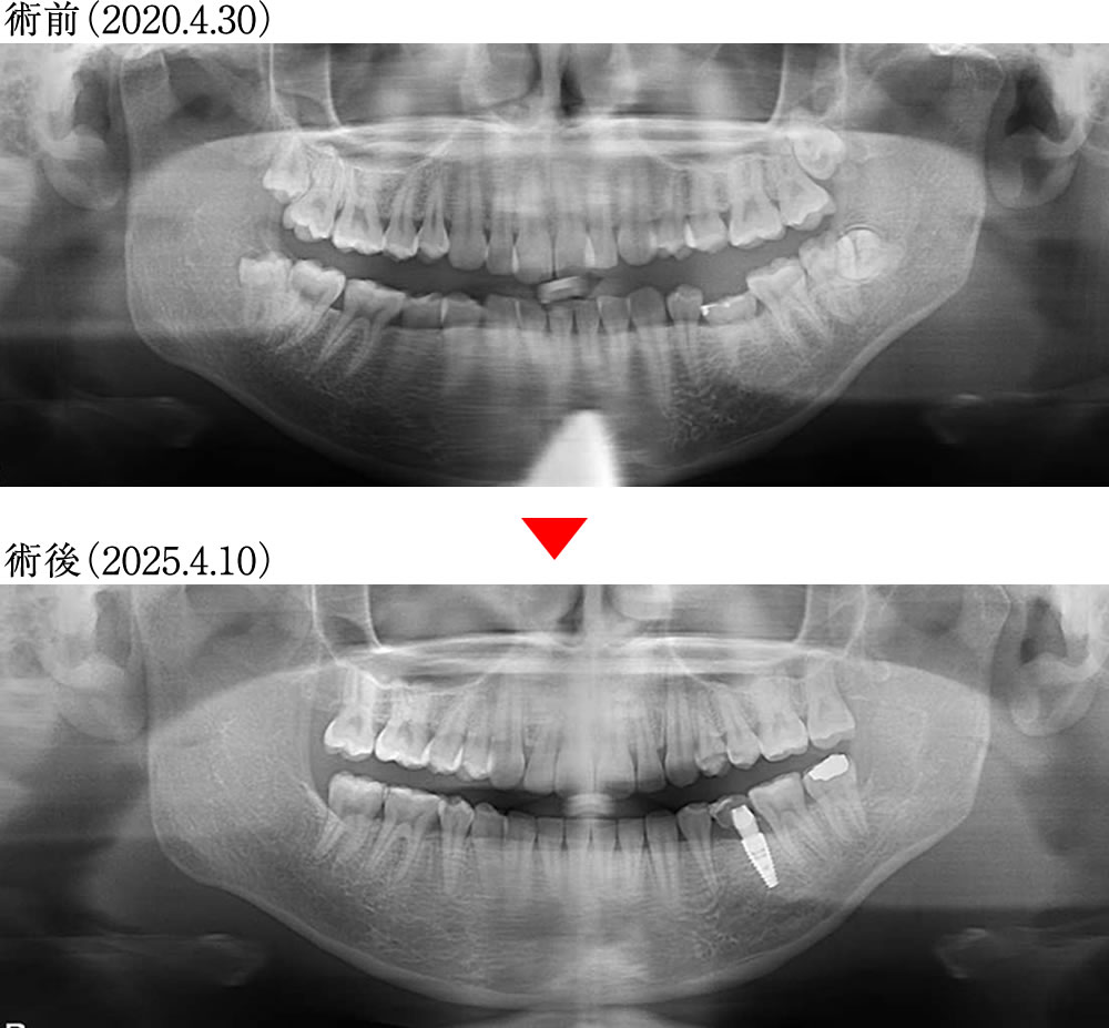 治療前後のレントゲン画像