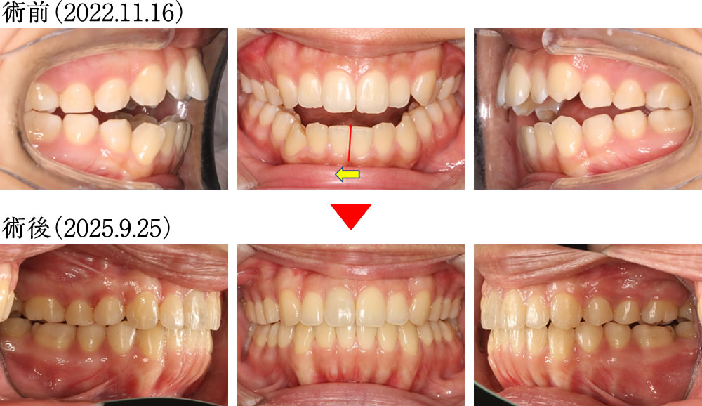 インプラントとマウスピース矯正よって咬み合わせを改善した症例
