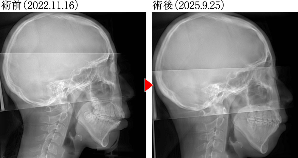 治療前後のレントゲン画像