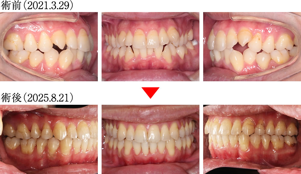 インプラントとマウスピース矯正よって咬み合わせを改善した症例