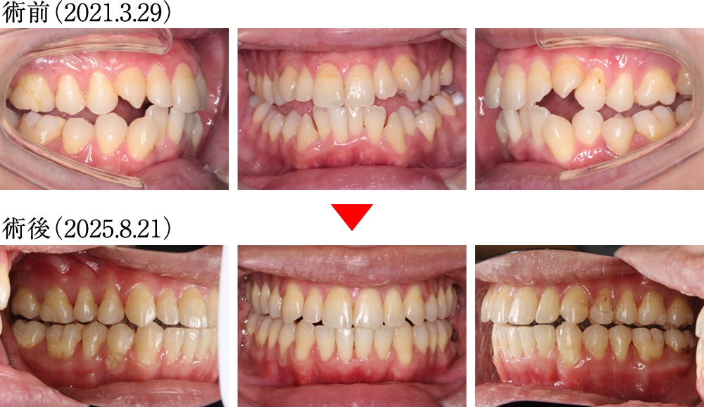偏心運動の変化