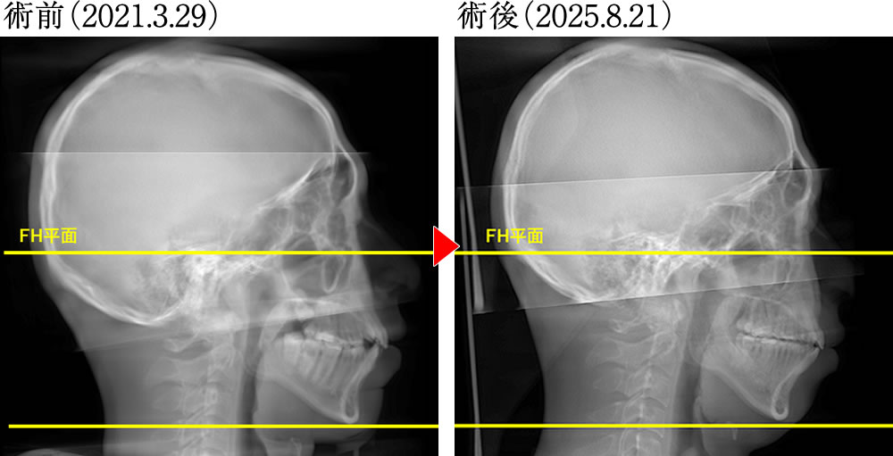 術前術後の骨格の変化