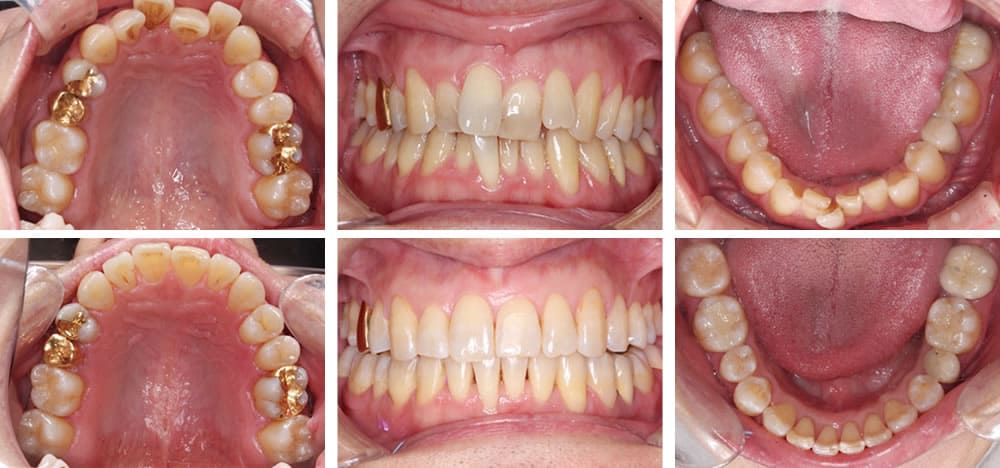 歯ぎしり治療の症例