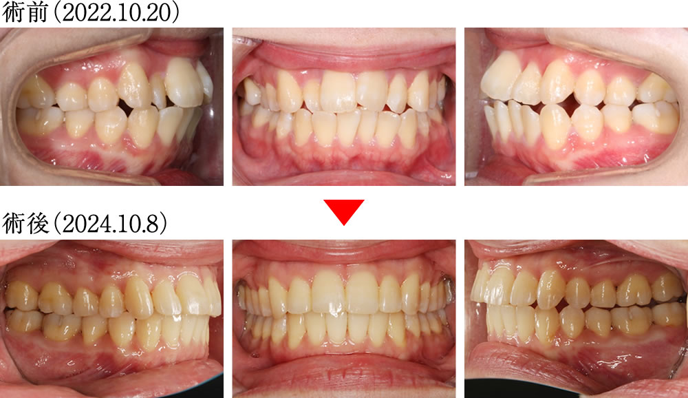 インプラントとマウスピース矯正よって咬み合わせを改善した症例