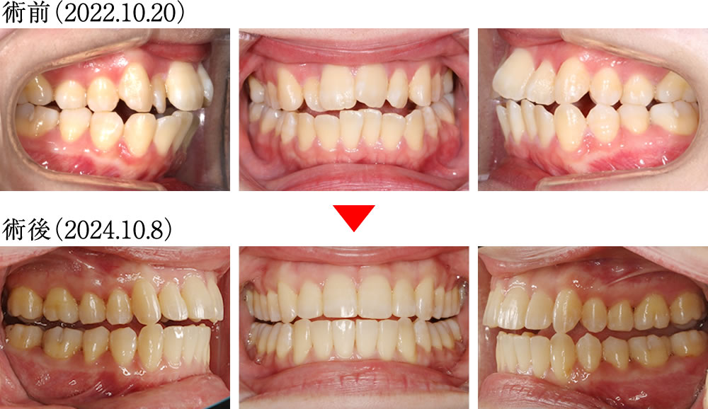 バッカルコリドーの変化