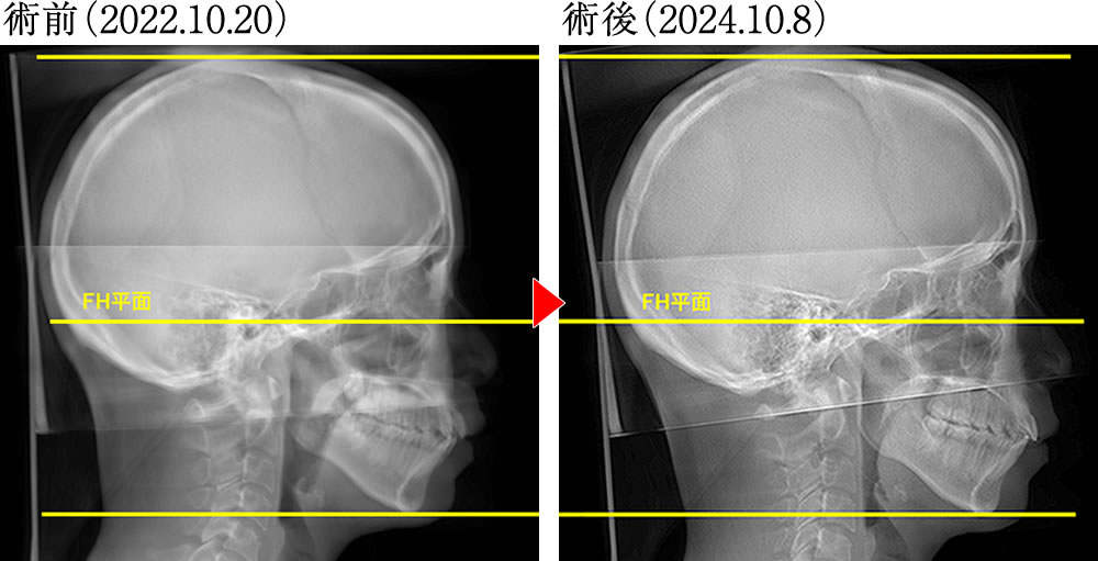 偏心運動の変化