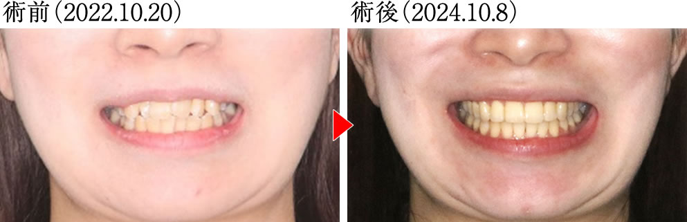 術前術後の骨格の変化