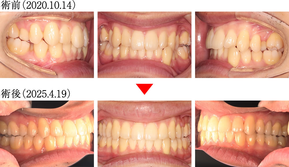 インプラントとマウスピース矯正よって咬み合わせを改善した症例