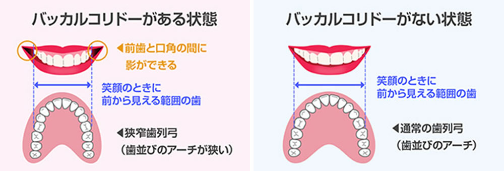 バッカルコリドーの変化