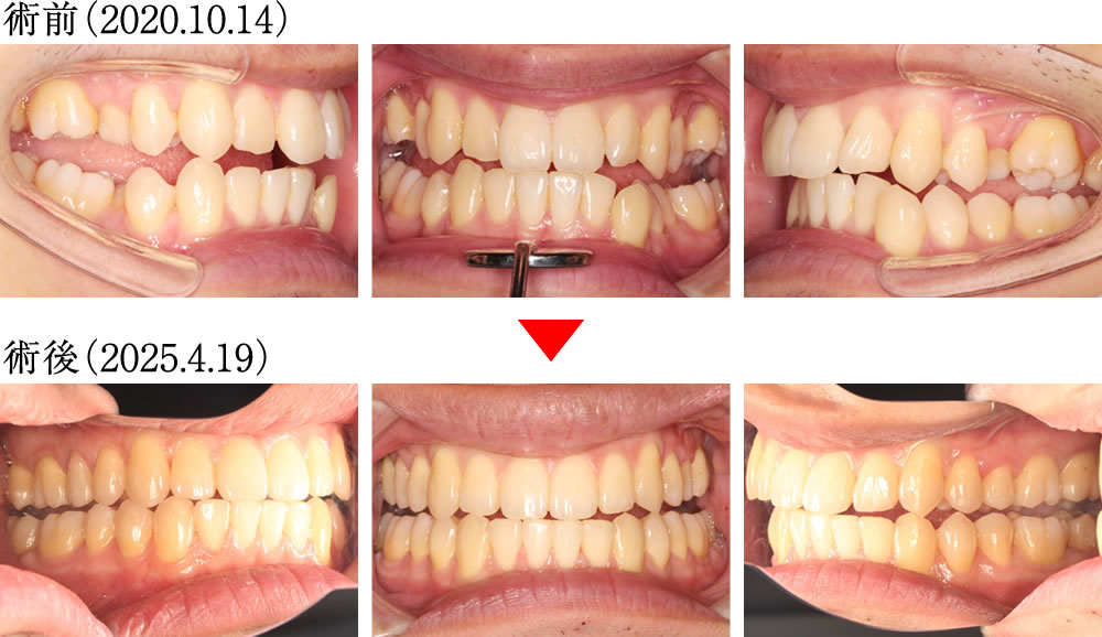 偏心運動の変化