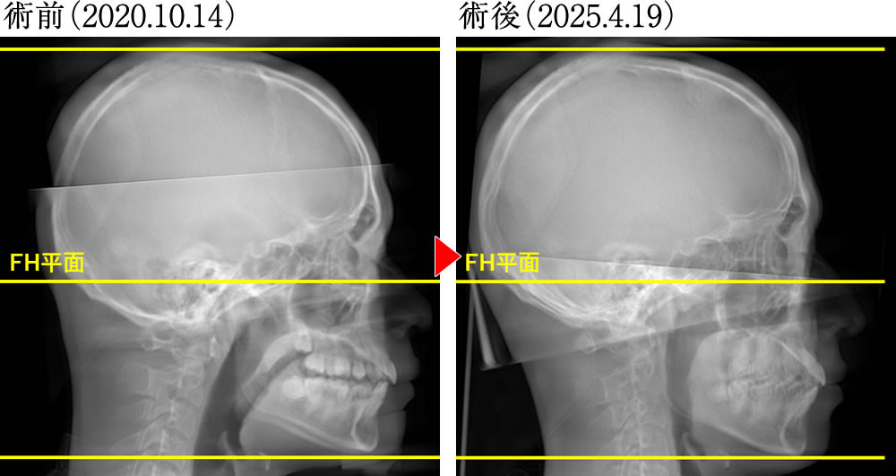 術前術後の骨格の変化