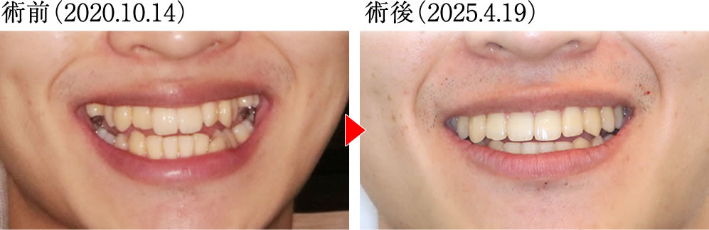 治療前後のレントゲン画像