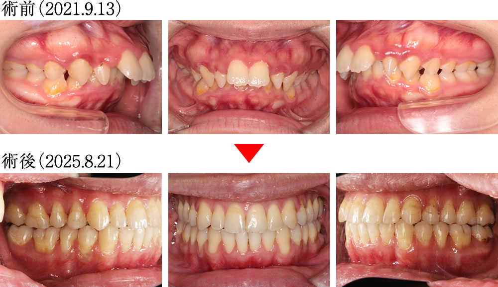 インプラントとマウスピース矯正よって咬み合わせを改善した症例