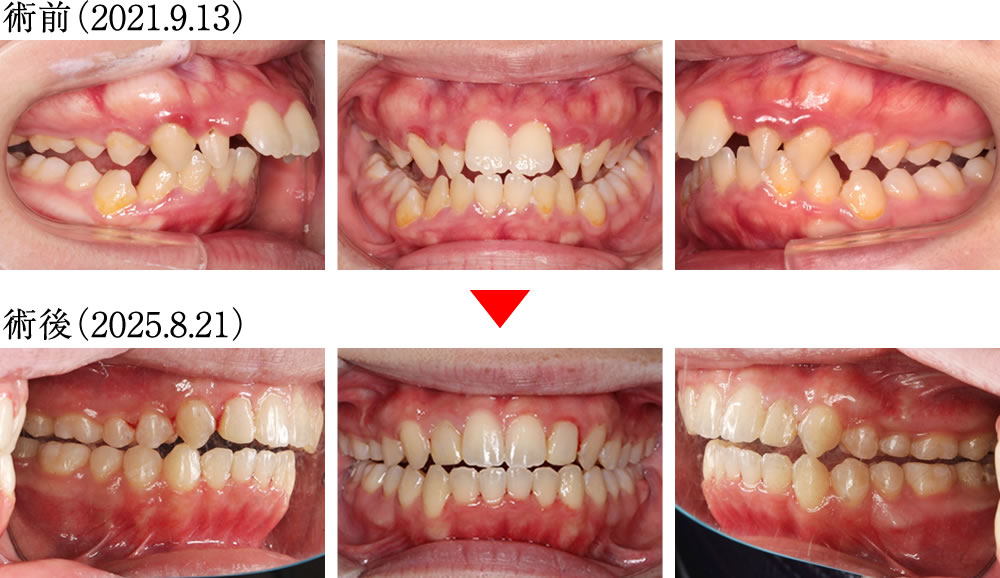 偏心運動の変化