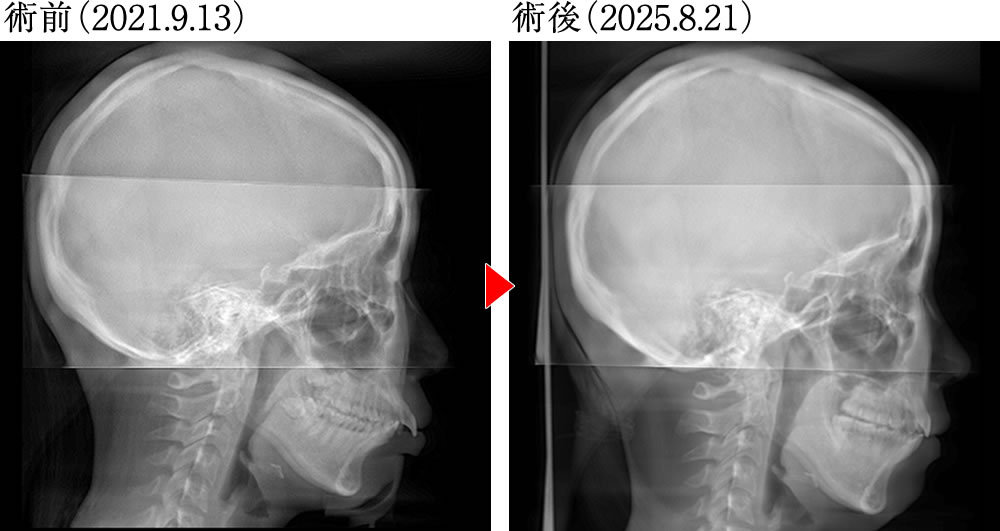 術前術後の骨格の変化