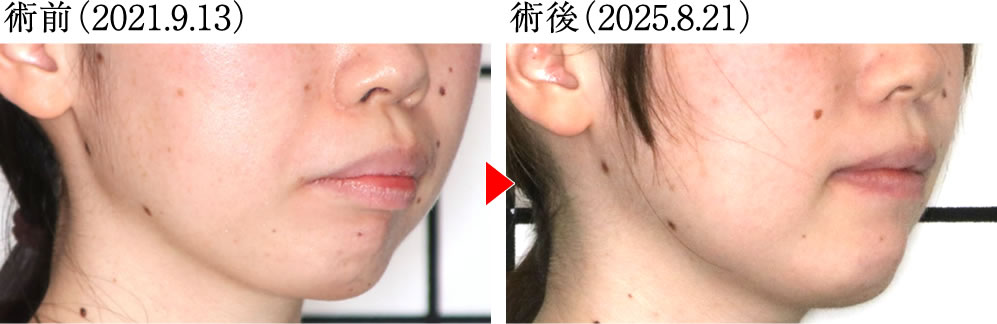 治療前後のレントゲン画像