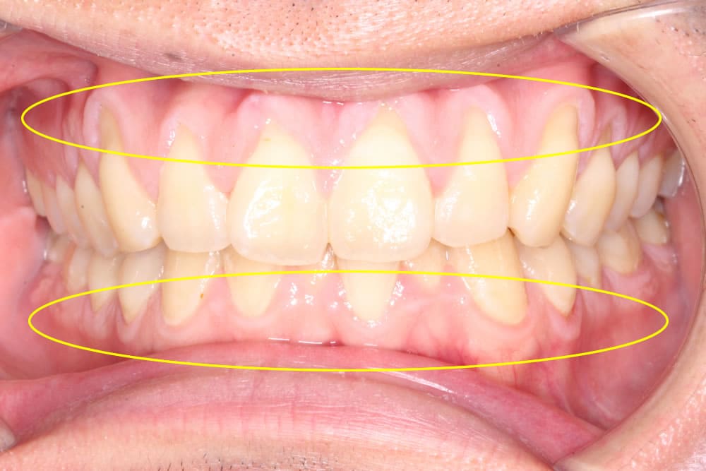 歯茎が下がる症状